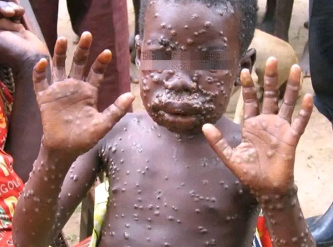 RDC : le Mpox frappe fort au Kasaï, 31 décès et 1236 cas enregistrés depuis Janvier 2026
